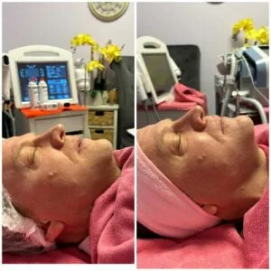 woman Before and After HIFU D