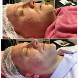 woman Before and After HIFU E