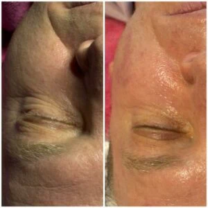 woman Before and After HIFU F