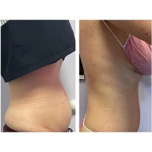 woman Before and After HIFU G