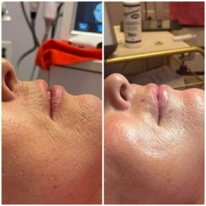 woman Before and After HIFU H