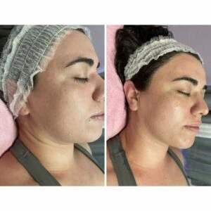woman Before and After HIFU I