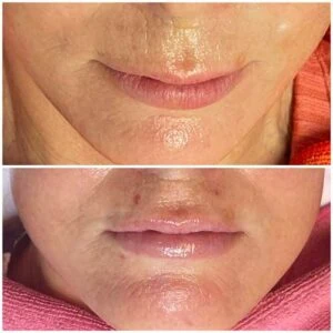 woman Before and After HIFU J
