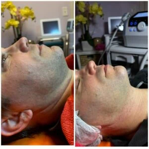 woman Before and After HIFU K