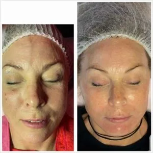 woman Before and After HIFU I