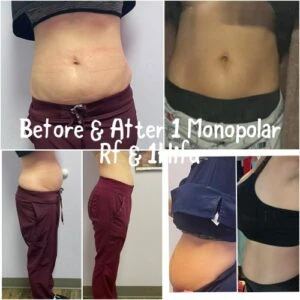 woman Before and After HIFU M