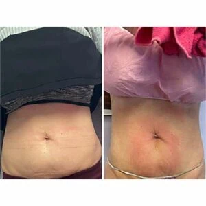 woman Before and After HIFU N