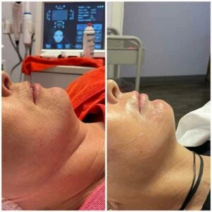 woman Before and After HIFU O