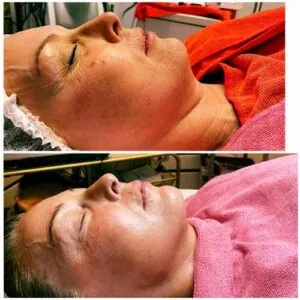 woman Before and After HIFU P
