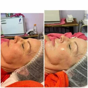 woman Before and After HIFU R