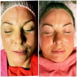 woman Before and After HIFU S