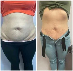 woman Before and After HIFU T