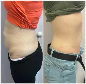 Before and After HIFU u