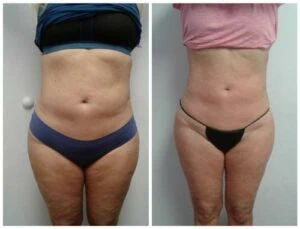 woman Before and After HIFU W