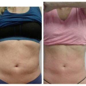 woman Before and After HIFU W
