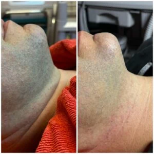 Man Before and After HIFU Y