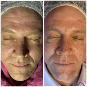 Man Before and After HIFU z