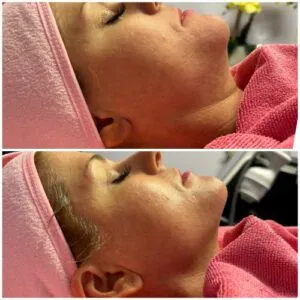 woman Before and After HIFU