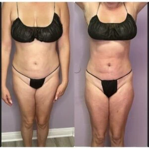 Waist and hip area before and after body sculpting.