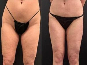 Liposlim treatment Before and After results at Petra's Weightloss Clinic Med Spa in Oklahoma City, OK