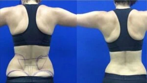 Liposlim treatment Before and After results at Petra's Weightloss Clinic Med Spa in Oklahoma City, OK