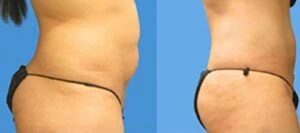 Liposlim treatment Before and After results at Petra's Weightloss Clinic Med Spa in Oklahoma City, OK