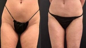 Liposlim treatment Before and After results at Petra's Weightloss Clinic Med Spa in Oklahoma City, OK