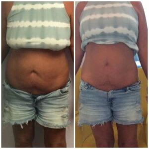 Liposlim treatment Before and After results at Petra's Weightloss Clinic Med Spa in Oklahoma City, OK
