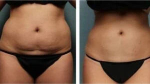 Liposlim treatment Before and After results at Petra's Weightloss Clinic Med Spa in Oklahoma City, OK