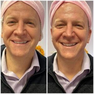 Man Before and After Lipozet Rf Radiofrequency A