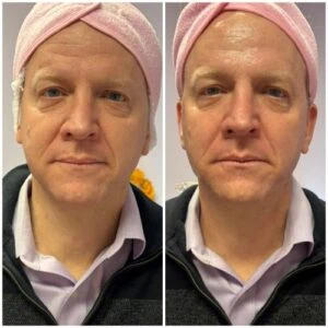 Man Before and After Lipozet Rf Radiofrequency B