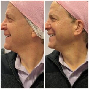 Man Before and After Lipozet Rf Radiofrequency C
