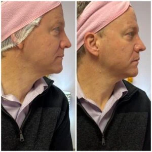Man Before and After Lipozet Rf Radiofrequency D