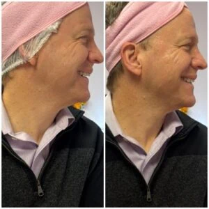 Man Before and After Lipozet Rf Radiofrequency E