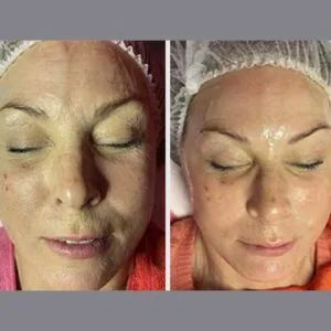 Woman Before and After Lipozet Rf Radiofrequency F