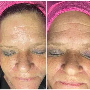 Before and After Lipozet Rf Radiofrequency