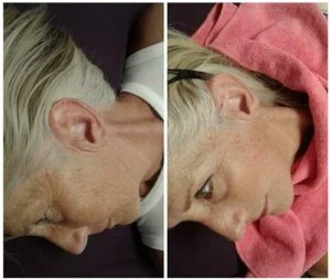 Side profile showing visible anti-aging improvements after facial treatment at Petra’s Weightloss Clinic