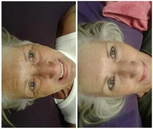Chin and jawline tightening results in before and after images at Petra’s Weightloss Clinic
