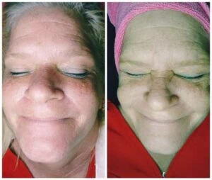 Facial anti-aging treatment results showing improved skin firmness at Petra’s Weightloss Clinic