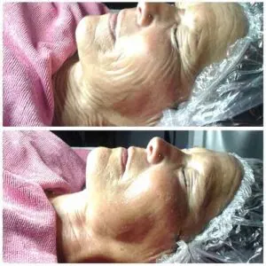 Full face tightening and brightening results at Petra’s Weightloss Clinic