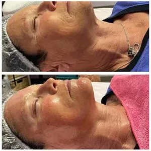 Side view facial contouring results in before and after comparison at Petra's Weightloss Clinic Med Spa in Oklahoma City, OK