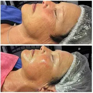 Facial rejuvenation showing smoother, brighter skin after treatment at Petra's Weightloss Clinic Med Spa in Oklahoma City, OK