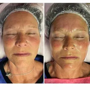 Before and after facial wrinkle-reduction results at Petra's Weightloss Clinic Med Spa in Oklahoma City, OK