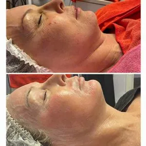 Facial tightening and rejuvenation results from med spa treatment at Petra's Weightloss Clinic Med Spa in Oklahoma City, OK