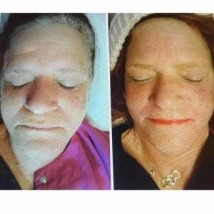 Before and After Lipozet Rf Radiofrequency at Petra's Weightloss Clinic Med Spa in Oklahoma City, OK