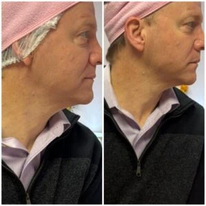 Before and After Lipozet RF Radiofrequency at Petra's Weightloss Clinic Med Spa in Oklahoma City, OK