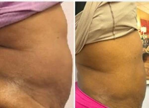 Monopolar Rf Before and After results at Petra's Weightloss Clinic Med Spa in Oklahoma City, OK