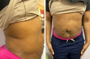 Monopolar Rf Before and After results at Petra's Weightloss Clinic Med Spa in Oklahoma City, OK