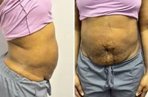 Monopolar Rf Before and After results at Petra's Weightloss Clinic Med Spa in Oklahoma City, OK