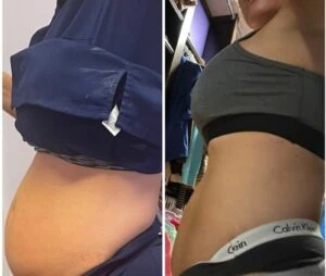 Monopolar Rf Before and After results at Petra's Weightloss Clinic Med Spa in Oklahoma City, OK